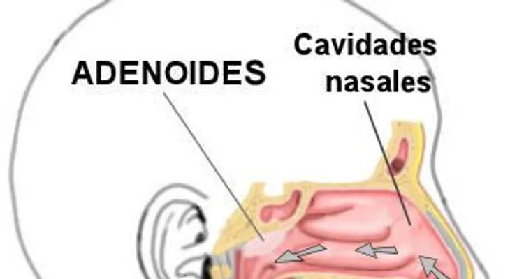 Adenoides, síntomas y tratamiento