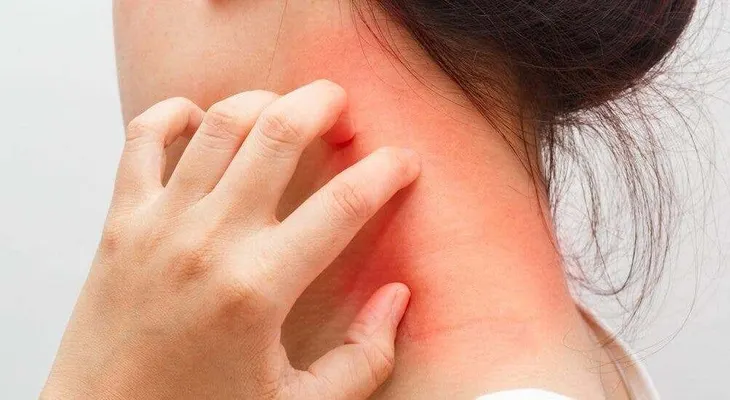 Dos de cada 10 adolescentes en Latinoamérica padecen dermatitis atópica