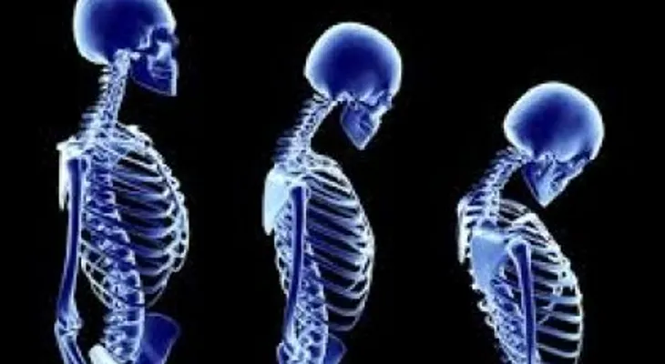 Osteoporosis: Una enfermedad silenciosa que también ataca a los hombres