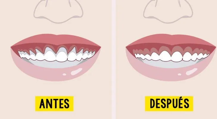 6 remedios naturales para combatir la retracción de las encías