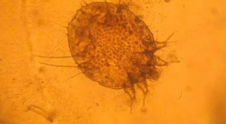 La sarna o escabiosis es una enfermedad de la piel que afecta a cualquier tipo de persona, rico o pobre