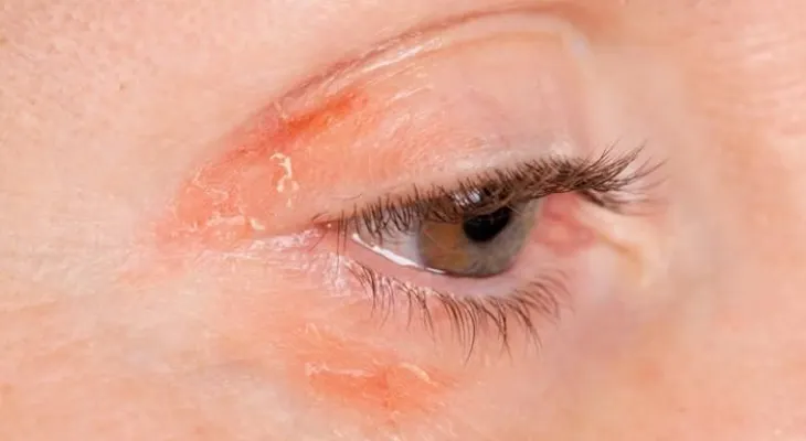 Los daños que puede traer usar maquillaje vencido