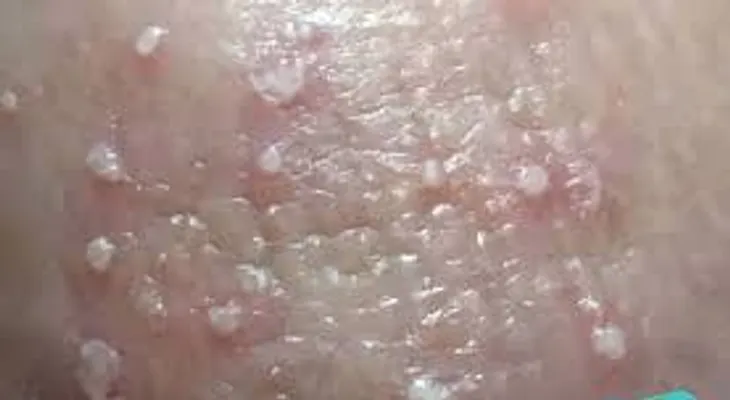 ¡Impactante revelación: La candidiasis es una enfermedad causada por el estrés y pasar mucho tiempo sentada