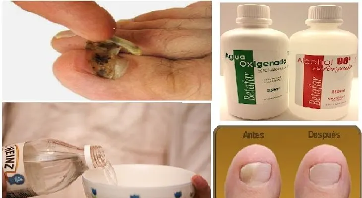 Elimina todos los hongos de las uñas de una pasada