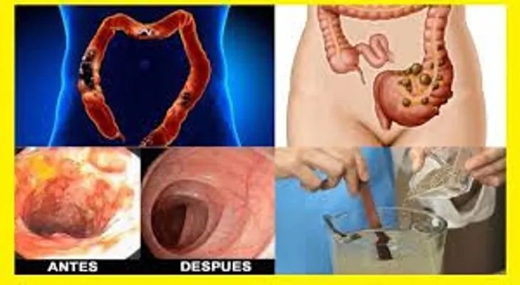 Excelente remedio que elimina toda la mugre y caca acumulada del colon