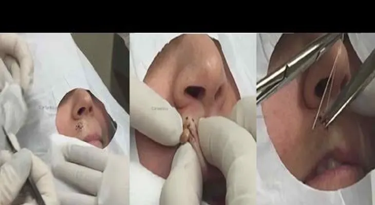 INCREIBLE: extracción de una espinilla de la cara de una señora