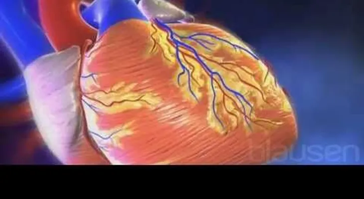 Observa cómo se produce un infarto de miocardio (VIDEO)