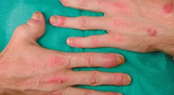 Artritis psoriásica: Deformación e inflamación articular