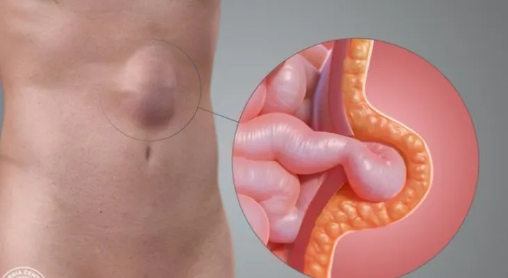 Las hernias abdominales son comunes, pero no necesariamente peligrosas