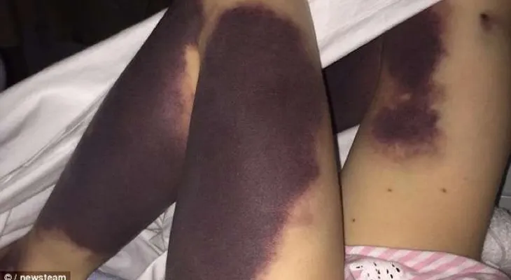 Esta niña de 4 años despertó con hematomas en todas sus piernas. La verdad te dejará sin palabras...