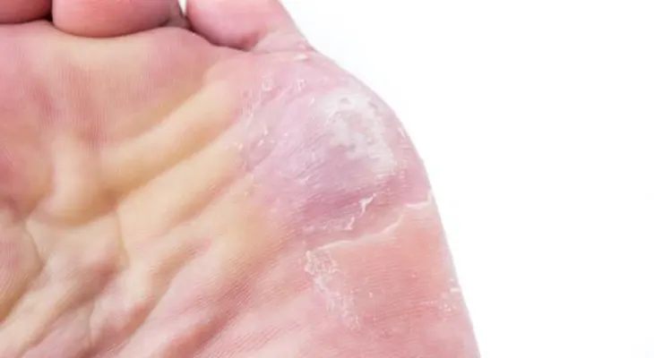 Por qué me pican los pies