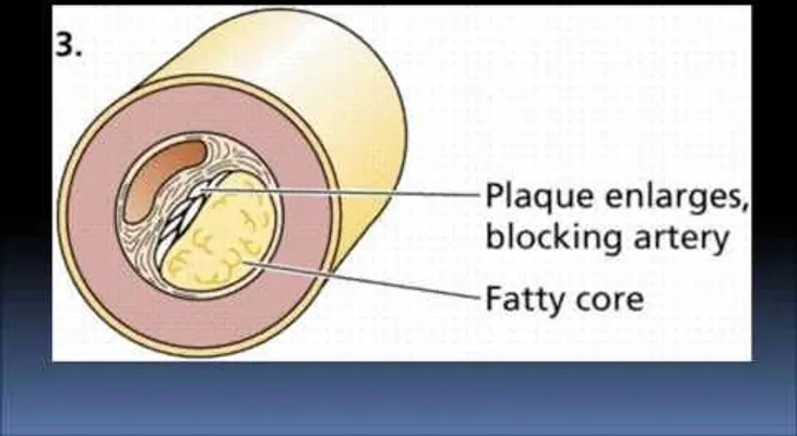 La hipertensión arterial es el factor de riesgo que produce más muertes (VIDEO)