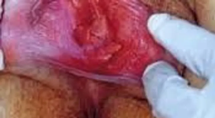 Curas para vestibulitis vulvar