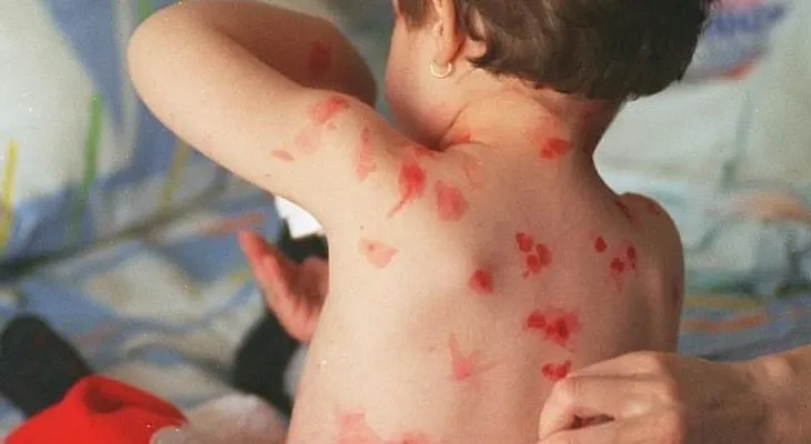Le dijeron que su hijo tenía varicela...pero se dio cuenta que los médicos cometían un error 