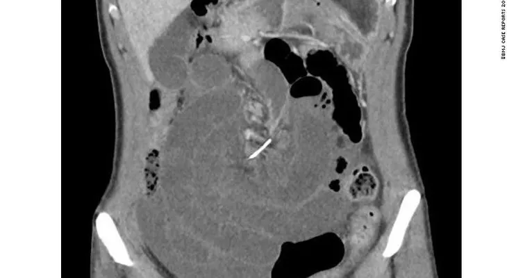 Esta mujer vivió 10 años con un alambre dental en su intestino