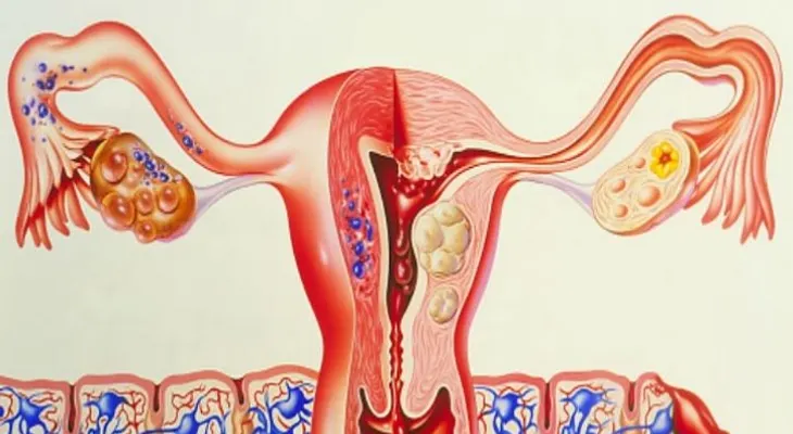 ¡Cuidado con el cáncer de ovario!