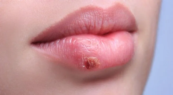 ¿Por qué el herpes labial siempre se repite?