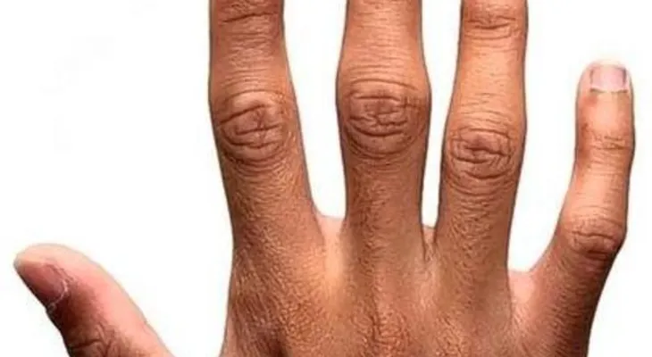 El dedo índice y anular diferente puede indicar mayor tendencia a ser lesbianas
