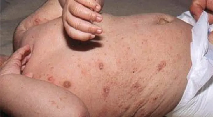 La sarna o escabiosis: enfermedad que puede contagiar a hombres y mujeres; descubre cómo se trata