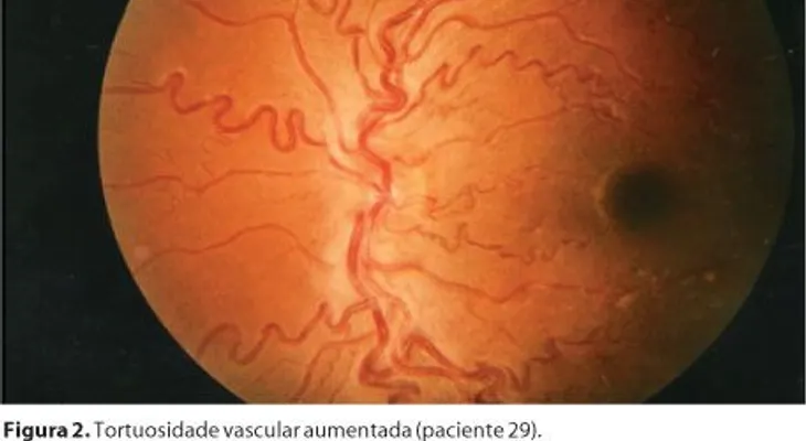 Retinopatía falcémica