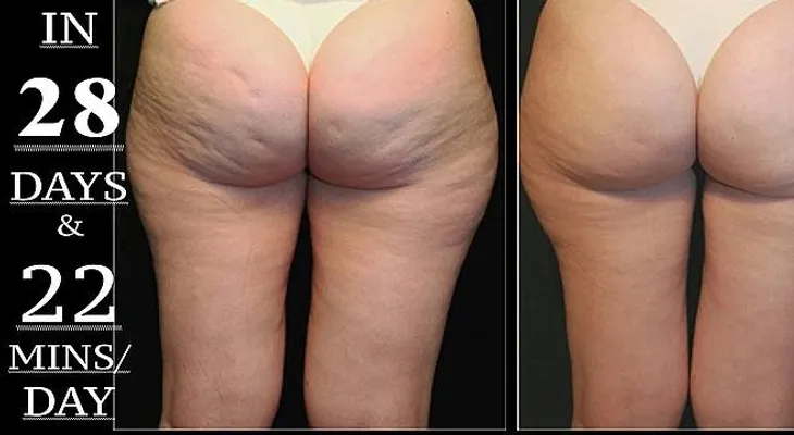 El uso correcto del vinagre de sidra de manzana para eliminar la celulitis en la noche ?
