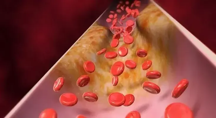 La acumulación de placas en las arterias (aterosclerosis) provoca un envejecimiento más rápido