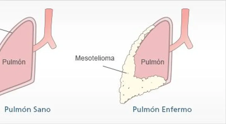Cura para el mesotelioma cáncer de pulmón