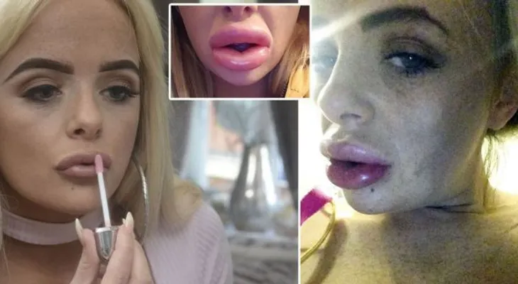 Dios mío: Mira como quedó esta mujer luego de un tratamiento de relleno de labios