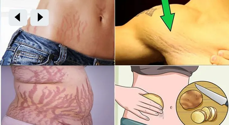 6 remedios naturales para eliminar las estrías rápido del cuerpo