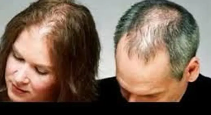 Descubra las razones que producen la calvicie en hombres y mujeres: 5 preguntas comunes