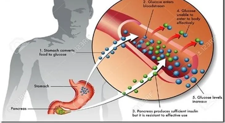 Un hombre se curó de la diabetes tipo 2, con esta toma 
