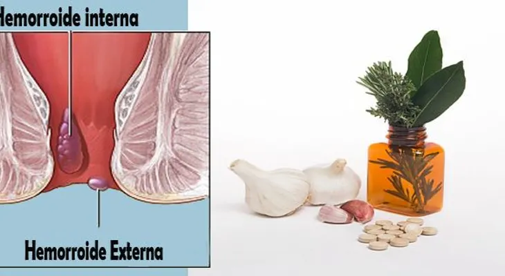 Acaba con las hemorroides internas y externas si aplicas uno de estos 6 remedios
