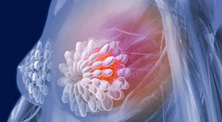 Nanopartículas para transportar un fármaco contra el cáncer de mama