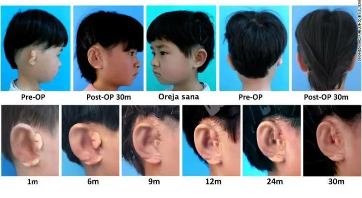 Científicos crean oídos nuevos para niños con una enfermedad llamada microtia