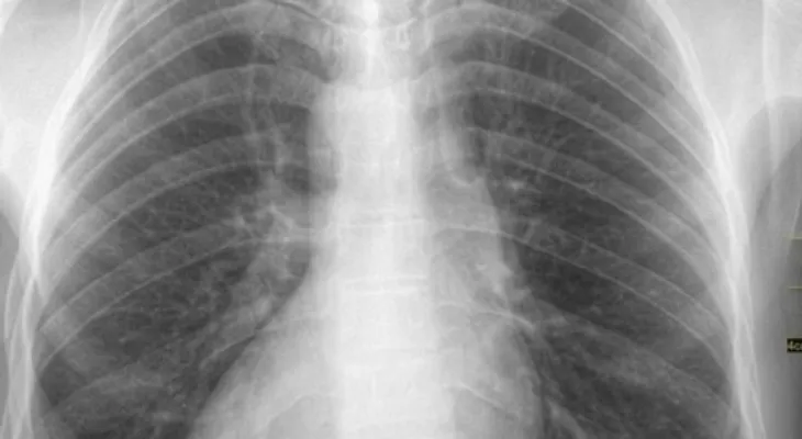 ¿ Qué es la cardiopatía del corazón al revés?