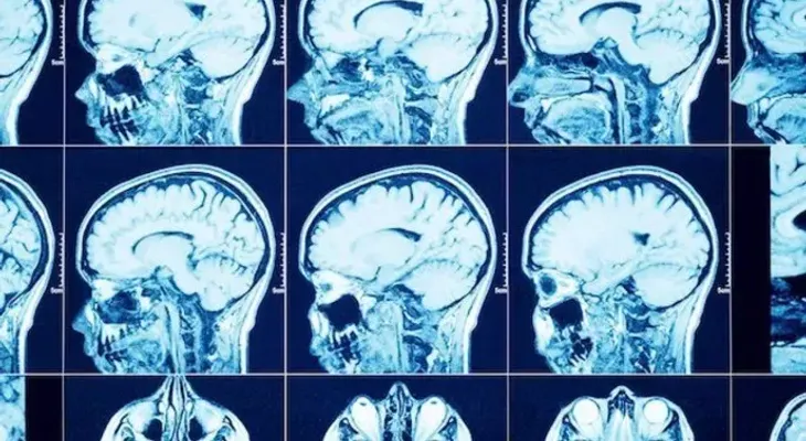 Crean un tumor cerebral activo en 3D que ayudará a investigar tratamientos