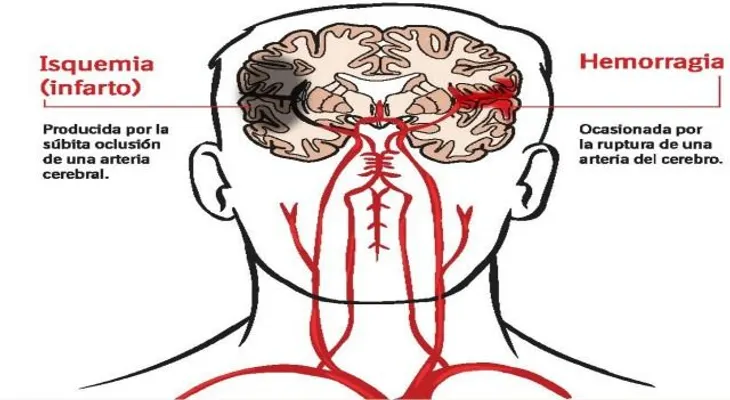 Accidente cerebrovascular tercera causa mortalidad en Venezuela