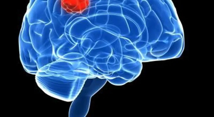 La obesidad aumenta el riesgo de tumores cerebrales