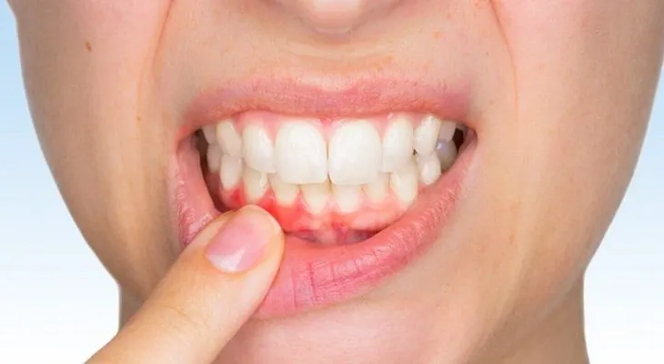 Signos de que tienes un absceso dental y cómo tratarlo naturalmente