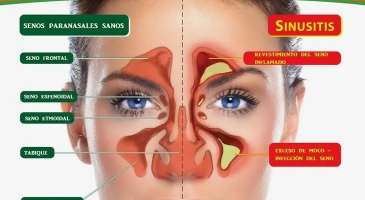 La fiebre es el signo más alarmante de la sinusitis maxilar: Tips para curarla 
