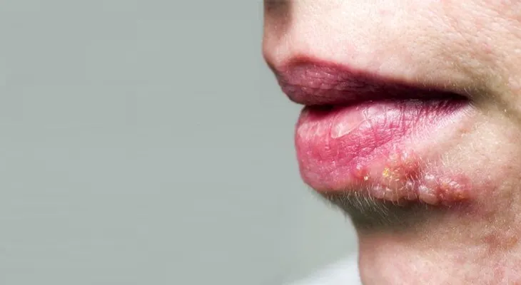 Herpes genital sus síntomas, causas y tratamientos naturales
