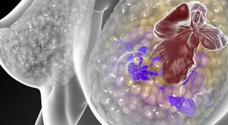 Explican cómo la obesidad promueve el cáncer de mama