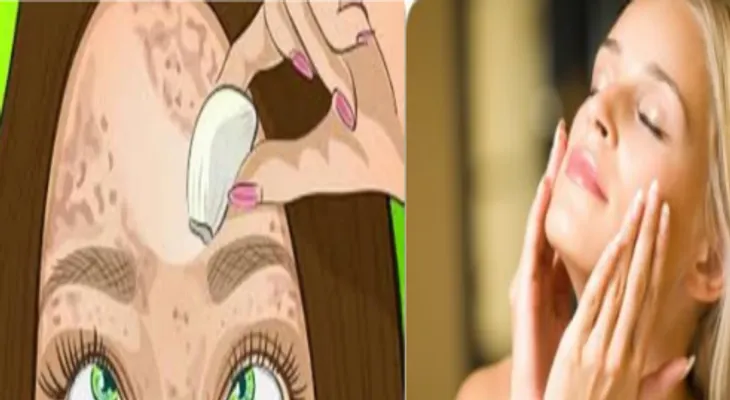 Imperdible remedio que borra las manchas como una goma en mujeres y hombres: Te deja una piel perfecta