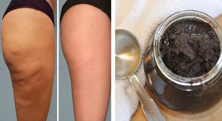 Una taza de café molido, de azúcar y aceite de oliva: remedio brasileño para la celulitis