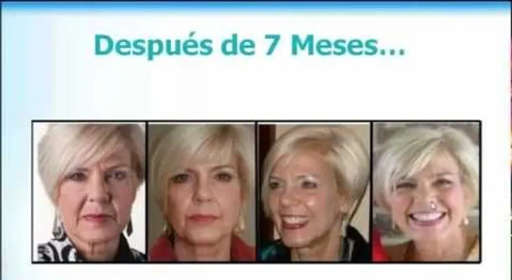 Como rejuvenecer hasta 15 años en 90 días sin botox ni cirugía