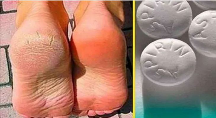 Nunca fue tan fácil eliminar las varices, los callos y los pies agrietados 