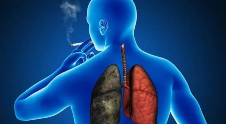 Estudiantes mexicanos desarrollan sistema para identificar pacientes con cáncer de pulmón