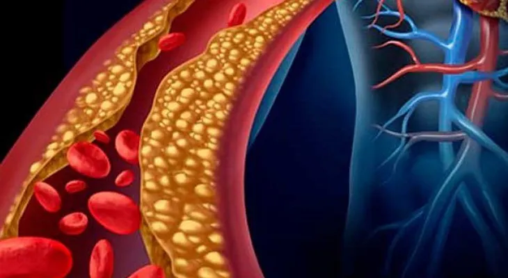 Esta es la forma natural más efectiva y rápida de bajar triglicéridos