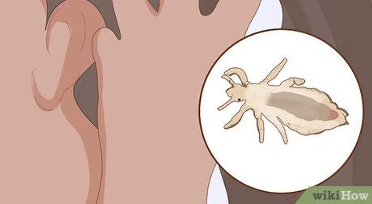 Los piojos y el covid-19 no diferencian ricos, ni pobres: Cómo prevenir los piojos