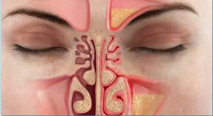 Elimina la congestión nasal en menos de un minuto